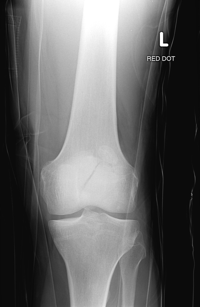 Xray Knee Aplateral Showing Fracture Patella Or Knee Cap